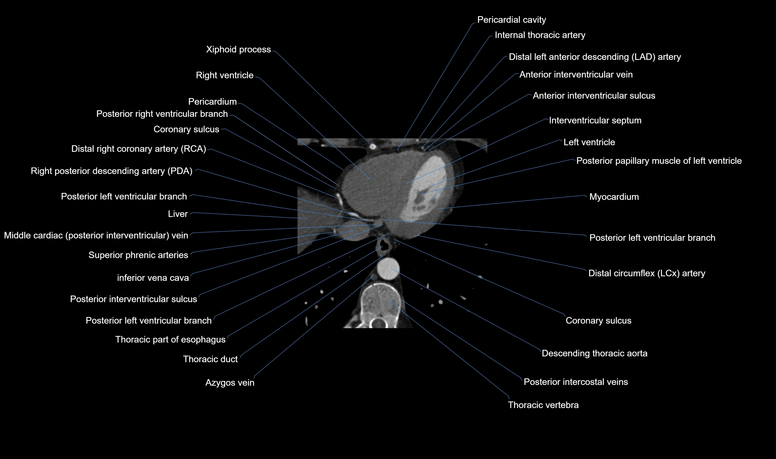 CT heart (coronary angiogram) axial view cross sectional anatomy labelled radiology image-00058.webp